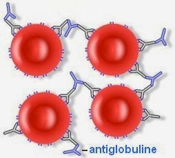 Schéma de l'agglutination grace à  l'antiglobuline humaine